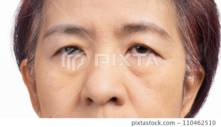 The ptosis or droopy eyelids in asian senior woman. 110462510