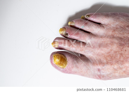 Closeup of a elderly woman foot with damaged nails because of fungus.Varicose veins on the womans legs Closeup of a elderly woman foot with damaged nails because of fungus.Varicose veins on the womans legs 110468681