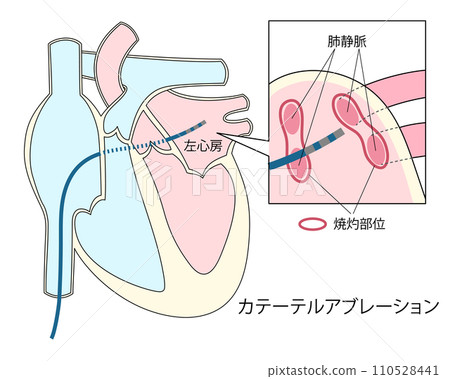 Illustration of catheter ablation for atrial fibrillation treatment 110528441