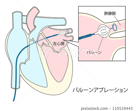 心房顫動球囊消融治療示意圖 心房顫動球囊消融治療示意圖 110528443