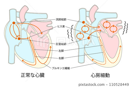 正常心臟與心房顫動對比圖 110528449