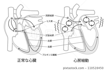 正常心臟與心房顫動黑白對比圖 正常心臟與心房顫動黑白對比圖 110528450