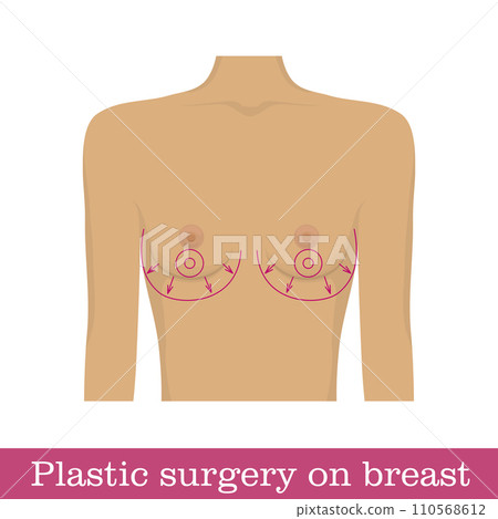 Plastic surgery breast augmentation infographic 110568612
