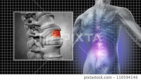 Spinal Fracture 110594148