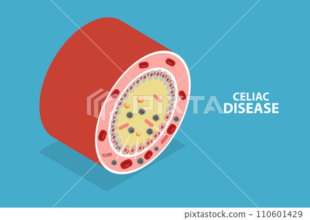3D Isometric Flat Vector Illustration of Celiac Disease 3D Isometric Flat Vector Illustration of Celiac Disease 110601429