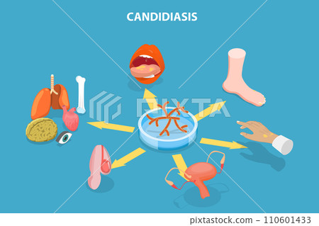 3D Isometric Flat Vector Illustration of Candidiasis 3D Isometric Flat Vector Illustration of Candidiasis 110601433