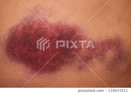 Accidents and wounds caused by impact. Purple skin bruises and abrasions. 110631911