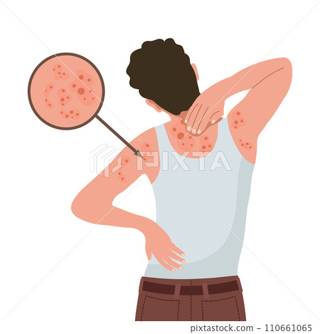 Allergic itching, skin inflammation, redness and irritation. Atopic dermatitis, eczema, psoriasis. Healthcare and medicine. Vector Allergic itching, skin inflammation, redness and irritation. Atopic dermatitis, eczema, psoriasis. Healthcare and medicine. Vector 110661065