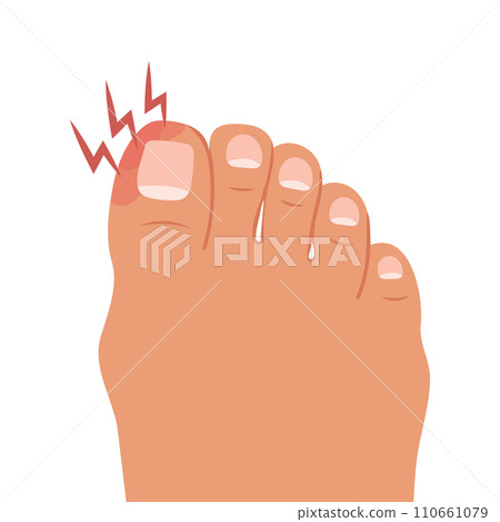 Swollen toe, onychocryptosis. Foot with nail disease or infection. Foot with onychomycosis or nail fungus. Healthcare and medicine. Vector 110661079