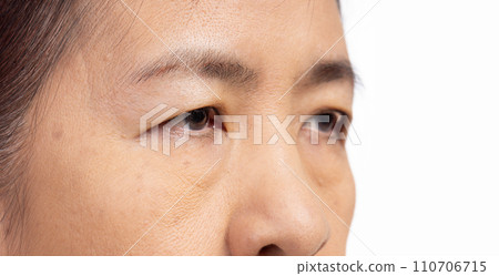 The ptosis or droopy eyelids in asian senior woman. 110706715