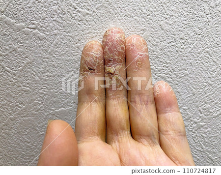 Patients with atopic dermatitis, skin tears due to pet allergies and exacerbation of shingles, hand eczema/chapped hands, autoimmune diseases Patients with atopic dermatitis, skin tears due to pet allergies and exacerbation of shingles, hand eczema/chapped hands, autoimmune diseases 110724817