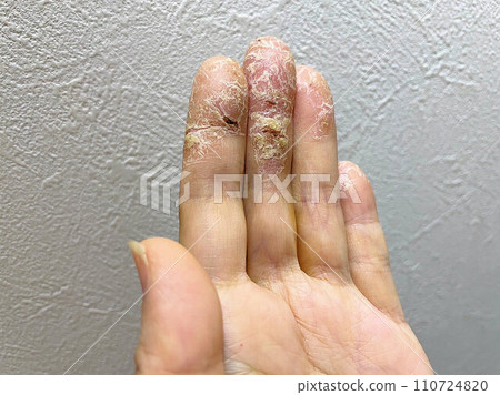 Patients with atopic dermatitis, skin tears due to pet allergies and exacerbation of shingles, hand eczema/chapped hands, autoimmune diseases 110724820