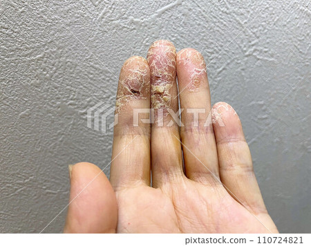 Patients with atopic dermatitis, skin tears due to pet allergies and exacerbation of shingles, hand eczema/chapped hands, autoimmune diseases 110724821