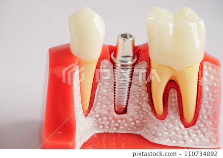 Dental implant, artificial tooth roots into jaw, root canal of dental treatment, gum disease, teeth model for dentist studying about dentistry. 110734892