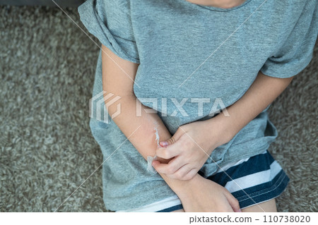 Little Asian boy's hands peeling off dry skin on his arm. Skin problems. 110738020
