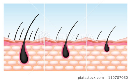 Scalp skin. Hair root reduce. Bulb or follicle fall. Baldness and growth structure. Nutrition drops treatment. Grow process. Epidermis and dermis microscopic diagram. Vector infographics 110787080