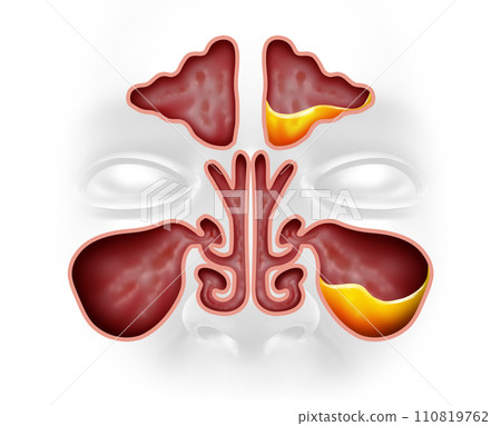 Sinusitis and Healthy Sinus 110819762