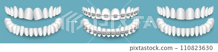 Dental braces before and after result vector illustration 110823630