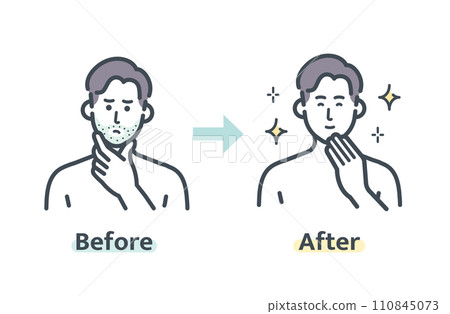 鬍鬚除毛前後 鬍鬚除毛前後 110845073