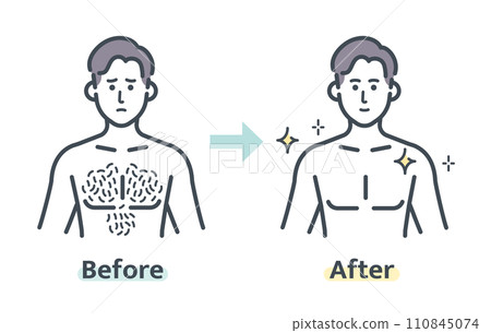 胸毛除毛前後 胸毛除毛前後 110845074