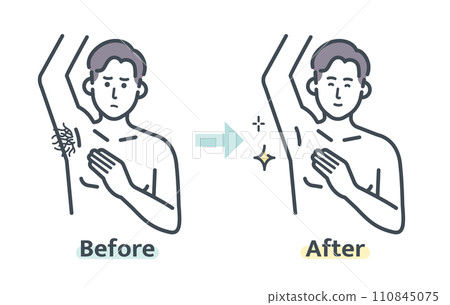 腋毛除毛前後 腋毛除毛前後 110845075
