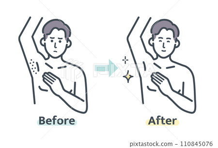 腋毛除毛前後 110845076