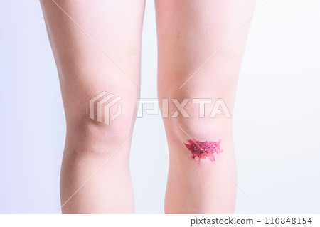 女子腿擦傷流血 女子腿擦傷流血 110848154