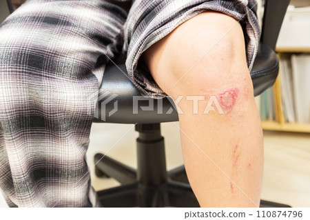 受傷的女人的膝蓋 110874796