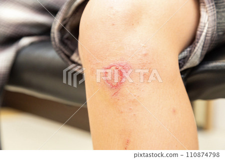 injured woman's knee 110874798