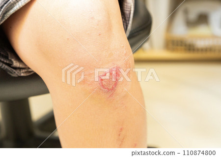 受傷的女人的膝蓋 受傷的女人的膝蓋 110874800
