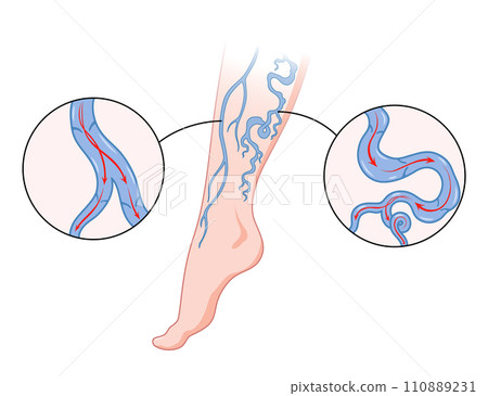 Varicose veins. Blue blood vessel visible through the skin, abnormally swollen leg. Vascular disease diagnostic and treatment. Venous insufficiency medical disease Varicose veins. Blue blood vessel visible through the skin, abnormally swollen leg. Vascular disease diagnostic and treatment. Venous insufficiency medical disease 110889231