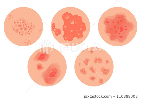 Different types of psoriasis vector set. Part of patients skin with dermatitis, inflammation, red rash and other skin problems. Cartoon illustration for disease concept Different types of psoriasis vector set. Part of patients skin with dermatitis, inflammation, red rash and other skin problems. Cartoon illustration for disease concept 110889308