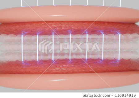 Laser shot through skin layer to collagen for Saggy skin and Facial treatment.  110914919