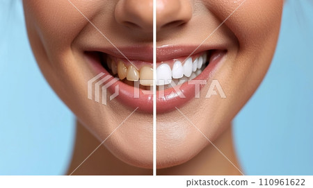 Radiant smile transformation  close up before and after dental whitening evolution 110961622