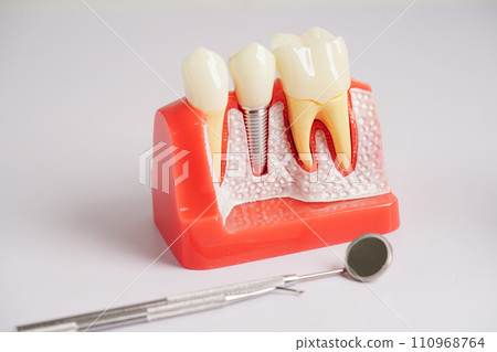 Dental implant, artificial tooth roots into jaw, root canal of dental treatment, gum disease, teeth model for dentist studying about dentistry.. 110968764