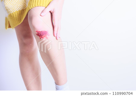 A woman's hand holds her abraded leg A woman's hand holds her abraded leg 110990704