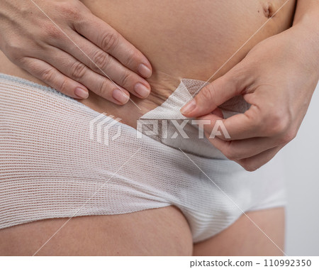 A woman tears a patch from a stitch after a caesarean section. 110992350