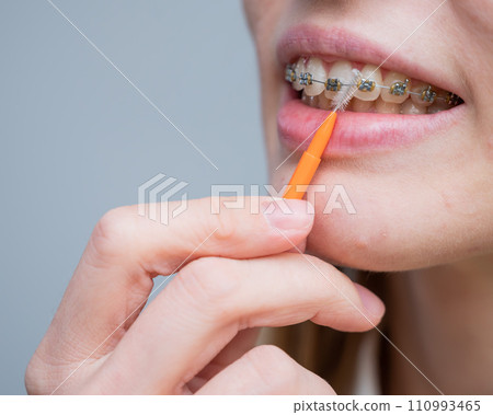 Unrecognizable Caucasian woman cleans braces with a brush. Close-up of female teeth with brackets Unrecognizable Caucasian woman cleans braces with a brush. Close-up of female teeth with brackets 110993465