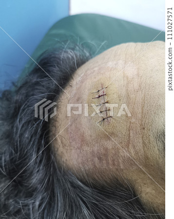 Stitched wound in forehead area from accident 111027571