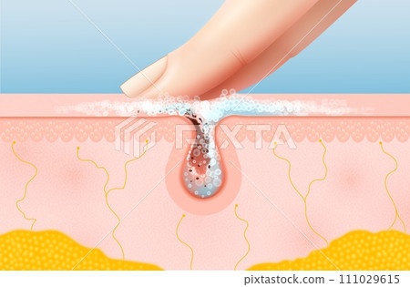 Skin pore cleaning realistic 3d vector cross-section view reveals finger removes debris and excess oil with foam, showcasing a cleansed epidermal layer for a refreshed and revitalized complexion Skin pore cleaning realistic 3d vector cross-section view reveals finger removes debris and excess oil with foam, showcasing a cleansed epidermal layer for a refreshed and revitalized complexion 111029615