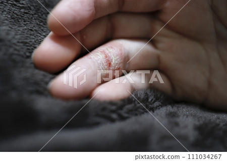 女子因手部濕疹手指乾裂 111034267