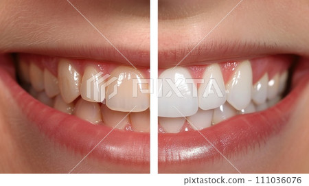 Before and After Teeth Whitening 111036076