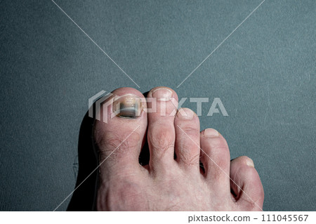 Damaged toenail. Hematoma on the thumb 111045567