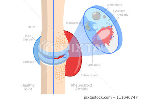 3D Isometric Flat  Conceptual Illustration of Rheumatoid Arthritis 111046747