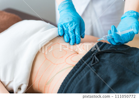 進行抽脂注射/溶脂注射手術的美容外科醫師/美容外科醫師 111050772