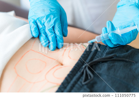 Cosmetic surgery doctor/cosmetic surgery who performs liposuction injection/fat dissolving injection surgery Cosmetic surgery doctor/cosmetic surgery who performs liposuction injection/fat dissolving injection surgery 111050775