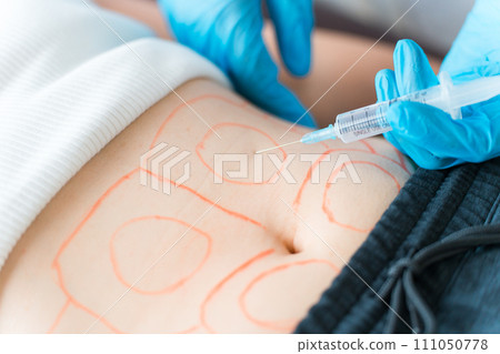 Cosmetic surgery doctor/cosmetic surgery who performs liposuction injection/fat dissolving injection surgery 111050778