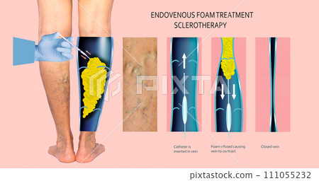 Endovenous laser treatment for varicose veins - foam sclerotherapy concept. 111055232