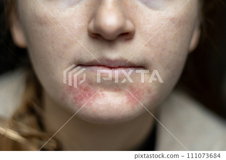 Perioral dermatitis on woman face. Closeup dermatitis on skin, ill allergic rash eczema skin of patient, atopic dermatitis symptom skin detail texture. The concept dermatology Perioral dermatitis on woman face. Closeup dermatitis on skin, ill allergic rash eczema skin of patient, atopic dermatitis symptom skin detail texture. The concept dermatology 111073684