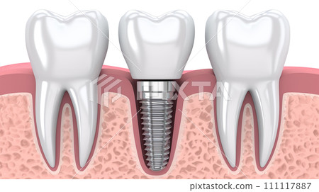 Illustration of teeth and implants 111117887